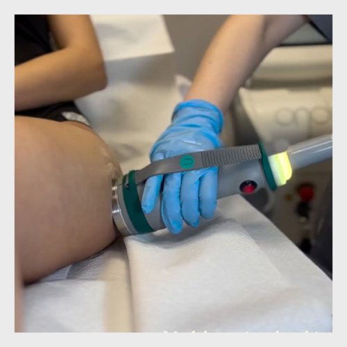 Available For Sale Deka Laser Onda Pro (NEW)